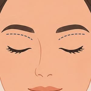 Browlift Face360 illustration Treatment